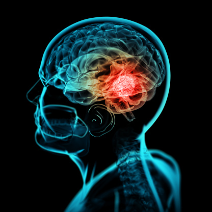 3D illustration of human brain tumor X-ray scan.