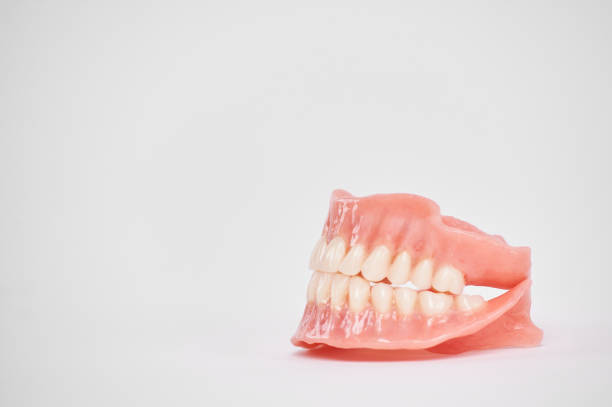 зубные протезы на белом фоне. красивые зубы керамические прессовые керамические коронки и виниры. - dentures стоковые фото и изображения
