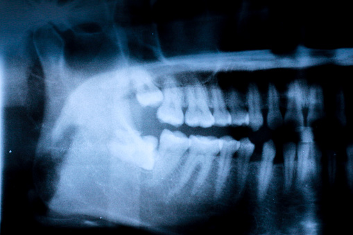 X-ray image of tooth impaction