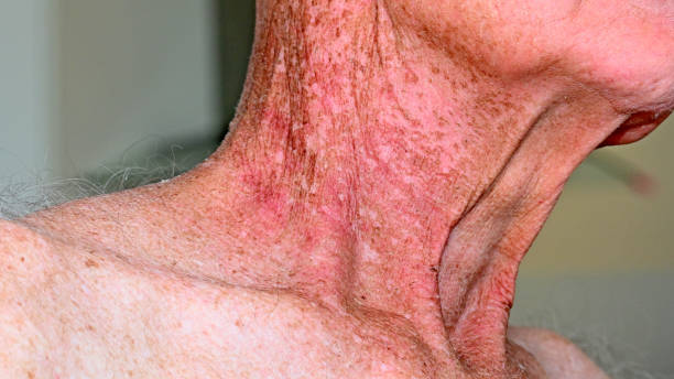 istock Side effects of radiation therapy 1454787406