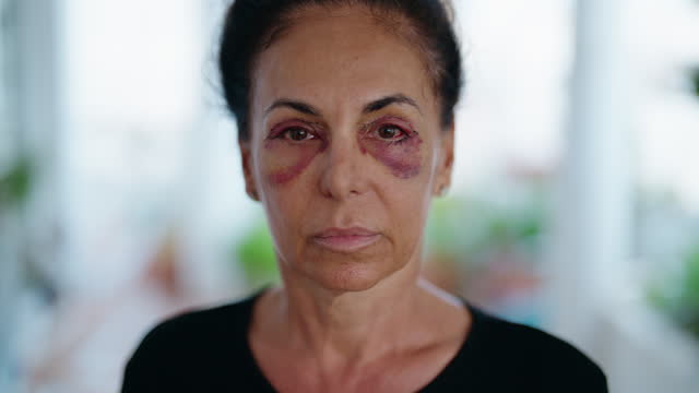 Middle age hispanic woman suffering for domestic violence with bruise on eyes at home terrace