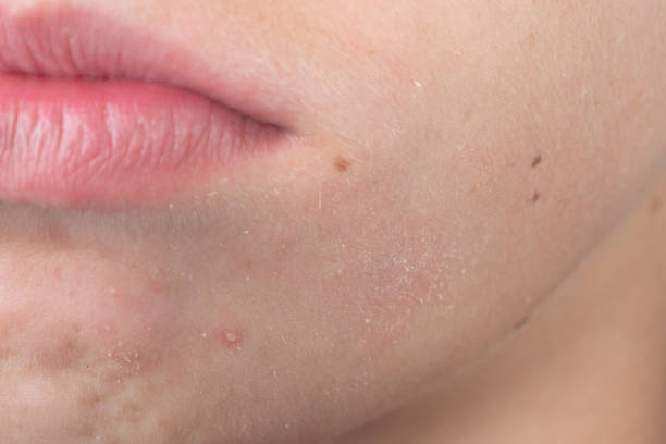 istock A teenager has a white pimple on his beard. 1454984260