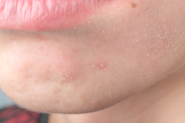 istock A teenager has a white pimple on his beard. 1454984343