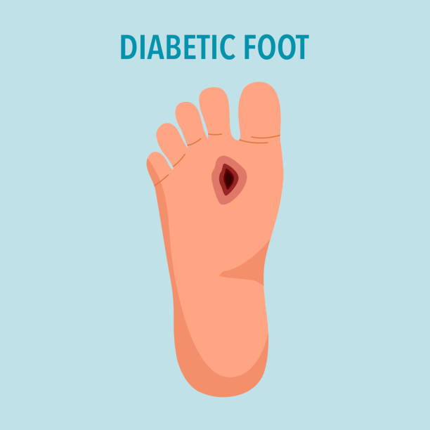 Diabetic foot syndrome concept vector illustration. vector art illustration