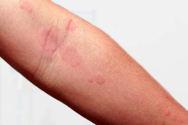 istock Around  arm of men with dermatitis problem of rash 1455150770