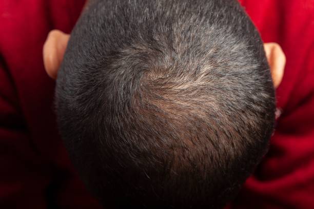 Itchy Scalp Photos Stock Photos, Pictures & Royalty-Free Images - iStock