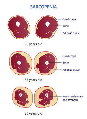 Infographic of sarcopenia vector illustration isolated on white background. Cross section of losing muscle mass and strength in different age. Anatomy and health care concept illustration.