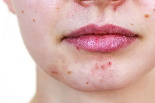 Young woman showing her face with acne and moles, dry lips. Teen girl no make up with red spots on her chin. Health problem, skin diseases.