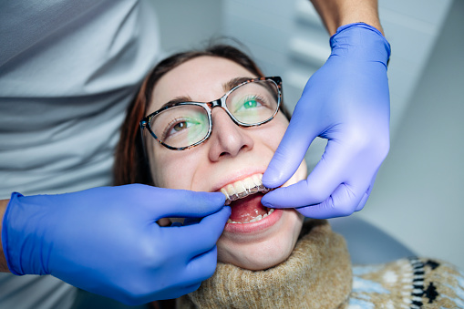 Close up shot of male orthodontist putting dental aligners on a patient.