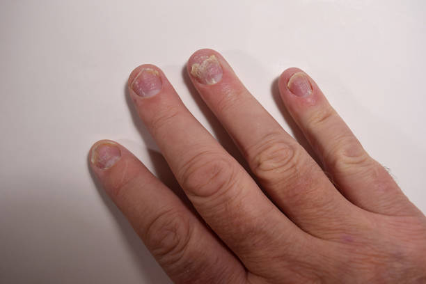 istock Plaque Psoriasis Nail Damage Genetic Disease caused by an Overactive Immune System 1455531209