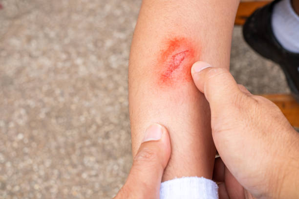 istock Father's hand holding baby's leg while injured leg ulcer caused by running fall, fresh wound on child's leg, health care concept 1455741512