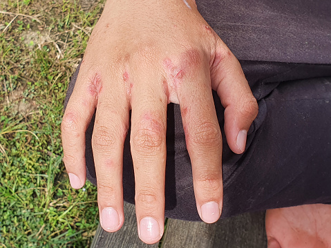 Primer plano de la mano con úlcera llena de pus condición causada por la infección de sarna photo