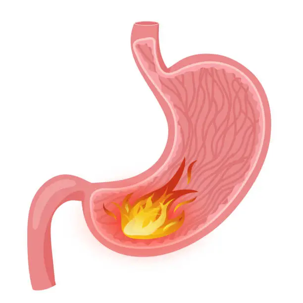 Vector illustration of Fire in stomach vector illustration