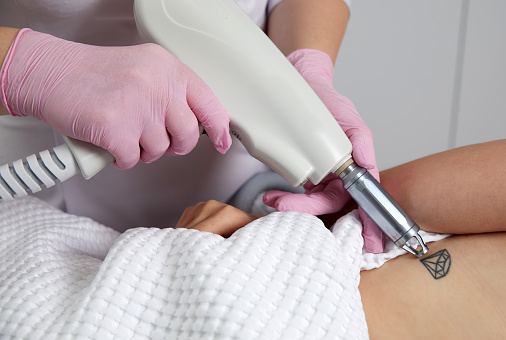 Beautician using laser device to remove an unwanted tattoo from female arm. Concept of erasing tattoos as expensive procedure in cosmetology clinic