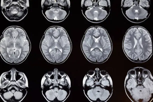 Macrophoto of computer tomography with the brain. Medical, scientific and educational MRI of the brain. Magnetic resonance imaging