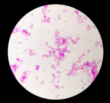 Microfotografía de tinción de Gram que muestra vaginosis bacteriana. photo
