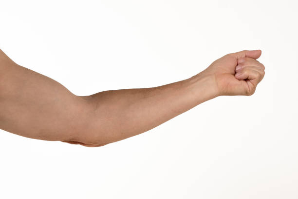 istock Osteoarthritis of the Elbow 1456260748