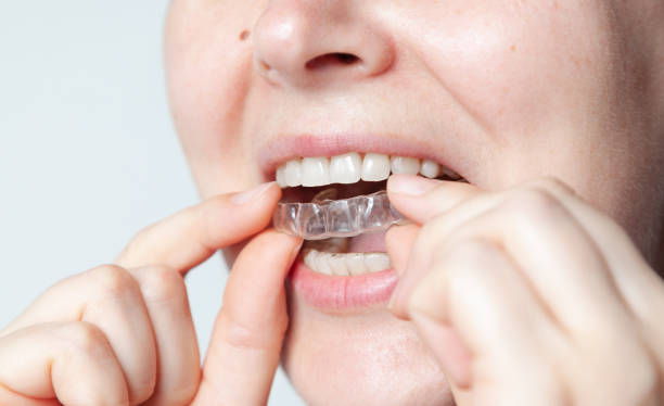 istock Caps for teeth after braces hold bite in desired position 1456385484