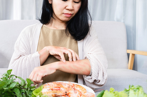 Asian woman have problems with itching rashes skin and scratching her arms caused by food allergies after eating shrimp