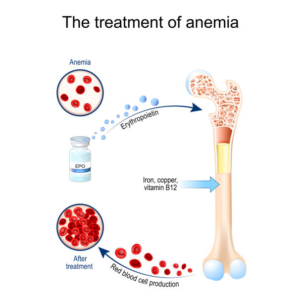 Erythropoietin and treatment of anemia. Vial with EPO. Erythropoietin and treatment of anemia. Glycoprotein cytokine that stimulates red blood cell production. erythropoiesis. Vial with EPO. anemia before and after therapy. Vector illustration erythropoietin stock illustrations