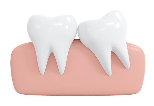 istock 3D Rendering partial wisdom teeth icon cartoon style isolated on white. 3D Render illustration. 1456707582