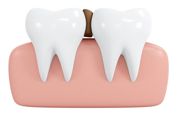 istock 3D Rendering teeth with food stuck in between icon cartoon style isolated on white. 3D Render illustration. 1456707586
