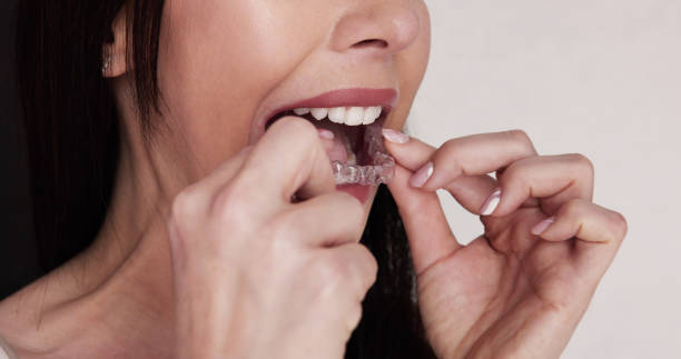 istock Clear Aligner Dental Night Guard 1456763162