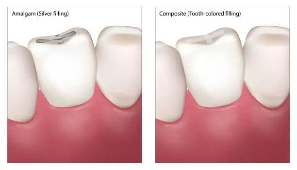 Vector illustration of Dental Filling Procedure. Amalgam Silver filling and Composite Tooth colored filling. Dental restorations