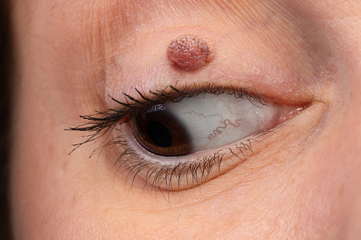 A woman's eye with an eyelid melanocytic nevus. Keratin cyst on the eyelid, a lump similar to a pailloma.