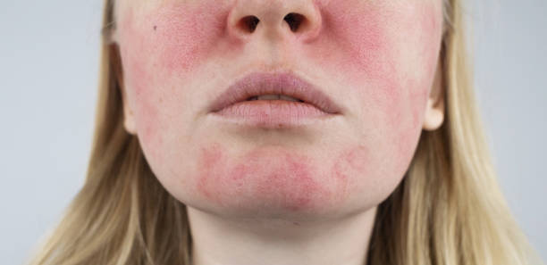 Rosacea face. The girl suffers from redness on her cheeks. Couperosis of the skin. Redness and capillary mesh are visible on the face. Treatment and removal. Vascular surgery and dermatology stock photo