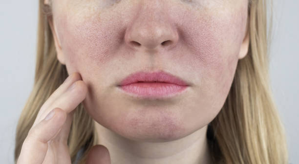Enlarged pores. Close-up of skin with large pores. Dermatology and cosmetology. Treatment of problems associated with oily skin. Couperose and rosacea stock photo