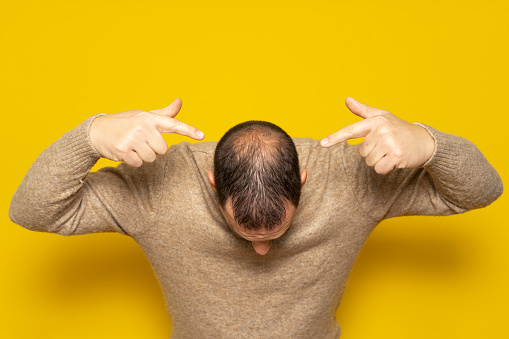 Human alopecia or hair loss. Middle-aged Latino man pointing to his head highlighting his incipient alopecia.