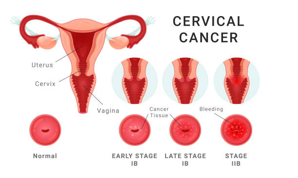 Cervical cancer stage medical healthcare educational scheme vector flat illustration vector art illustration
