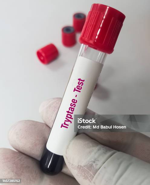 Tryptase Testing Blood Sample For Tryptase Test A Tryptase Test Can Help Doctors ...