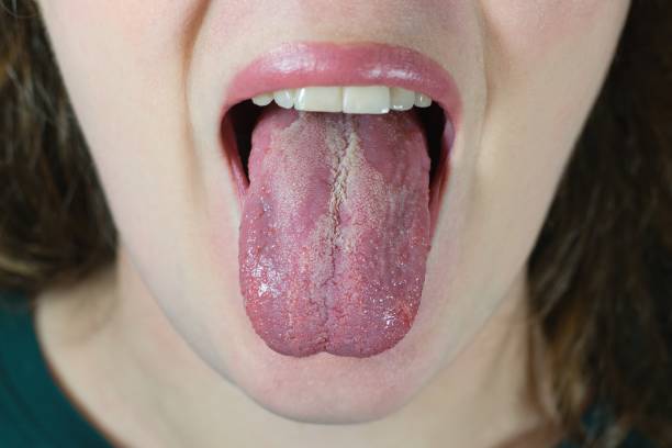 口腔カンジダ症または口腔ツグミ(カンジダアルビカンス)、ヒト舌のイースト菌感染症。 - caucasian cavity clinic color image ストックフォトと画像