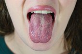 Oral Candidiasis or Oral trush (Candida albicans), yeast infection on the human tongue.