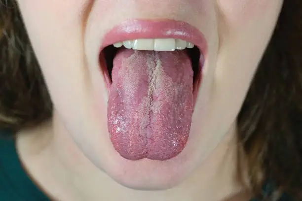 Oral Candidiasis or Oral trush (Candida albicans), yeast infection on the human tongue, common side effect when using antibiotics or another medicaments. Young woman with low immunity.