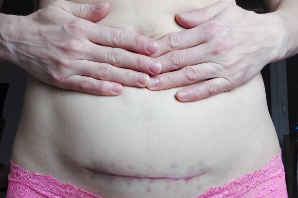 istock Suture after cesarean section with removable threads. The third month after the operation. Delivery by caesarean section. 1457427217