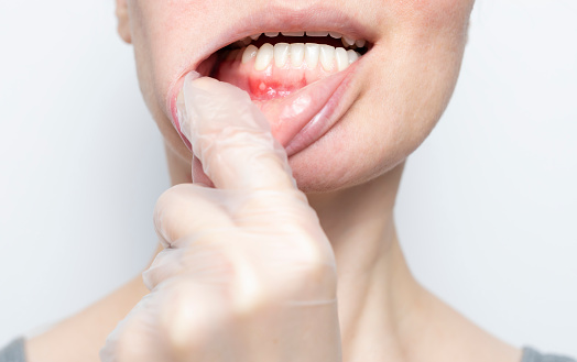 Caucasian woman aphthous ulcers on mouth on white background
