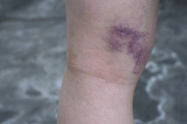 istock Bruise at back of the knee. 1457529197