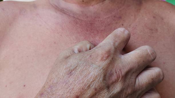 The inflammation and rash hives itchy skin, allergy and pimple on the body. portrait showing the flabbiness skin, rash and hives skin, allergic reaction and infection on the body of the male patient, health care and medical concept. leprosy stock pictures, royalty-free photos & images