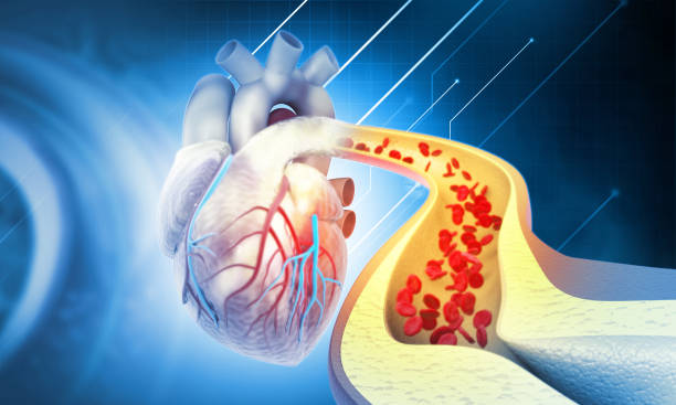 Cholesterol blocked artery with heart. 3d illustration stock photo