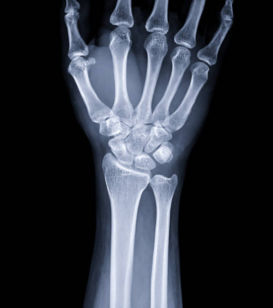 imagen radiográfica de la articulación de la muñeca para el diagnóstico de artritis reumatoide. - hueso de la muñeca fotografías e imágenes de stock