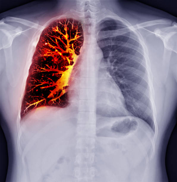 fusion image of chest x-ray and ct chest  coronal view  for lung infection from covid-19 concept. - bronquiolite imagens e fotografias de stock