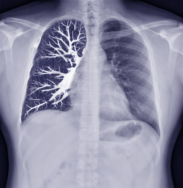 Fusion image of Chest x-ray and CT Chest  Coronal view  for lung infection from covid-19 Concept. stock photo