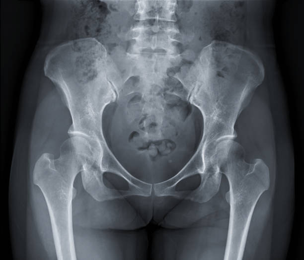X-ray image of Pelvic bone. stock photo