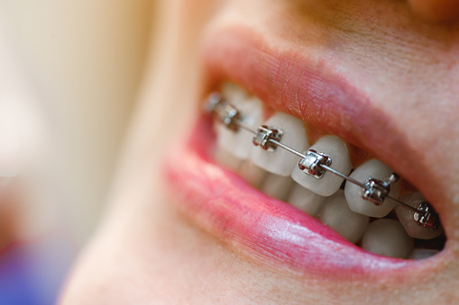 Dental braces in happy womans mouths on brackets on the teeth after whitening. Self-ligating brackets for perfect smile. Orthodontic teeth treatment.