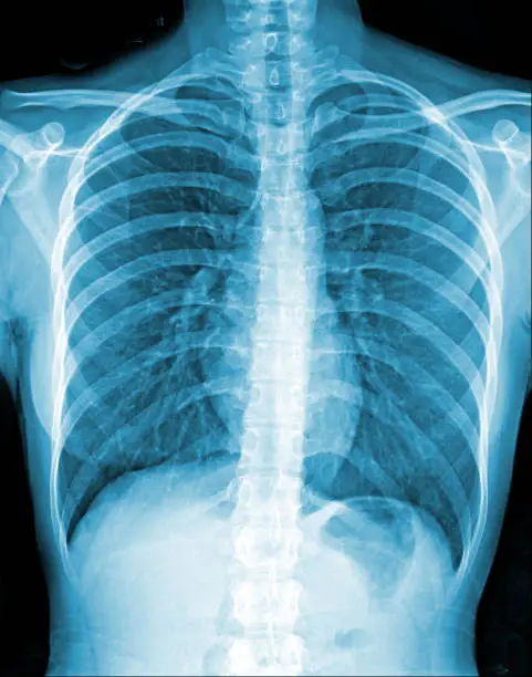 Film chest x-ray show alveolar infiltrate at left middle lung