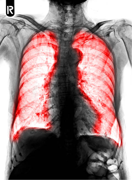 tuberculosis. la radiografía de tórax muestra fibrosis, infiltración intersticial tanto pulmonar como en zona roja - interstitial fotografías e imágenes de stock