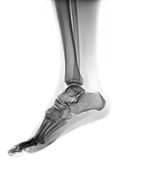 istock X-ray normal human foot . Lateral view 1457829684